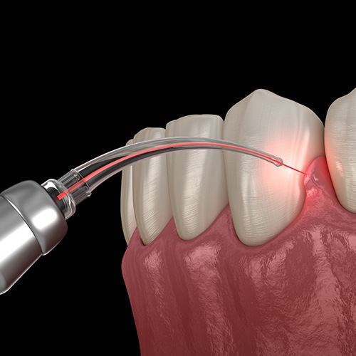 Animated smile during soft tissue diode laser dentistry treatment
