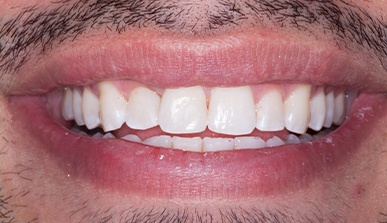 Closeup of smile after Invisalign and dental bonding treatment