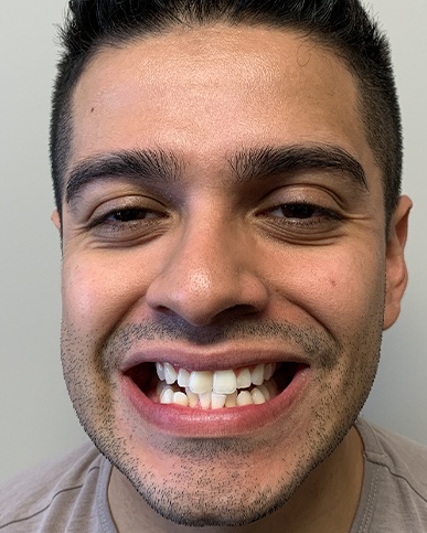 Patient's imperfect smile before Invisalign and dental bonding treatment