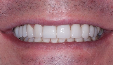 Closeup of brilliant smile after dental restoration and cosmetic dentistry
