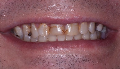 Closeup of discolored teeth before dental restoration and cosmetic dentistry