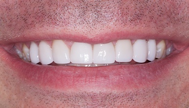 Closeup of man's flawless smile after porcelain veneers