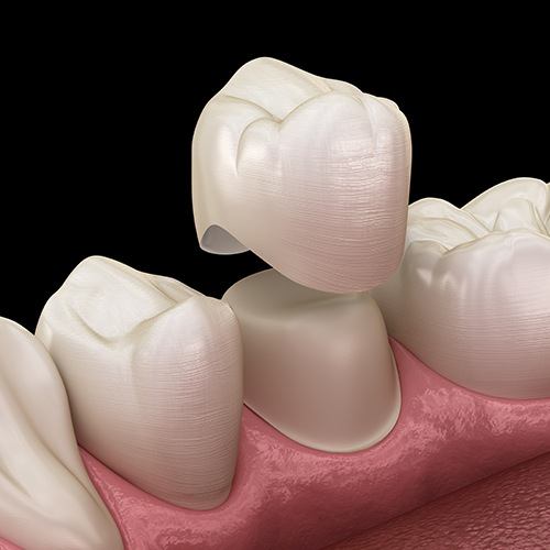 Animated metal free dental crown placement