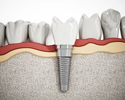 Dental implant in Willowbrook in lower arch