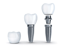 dental implant with an abutment and crown 