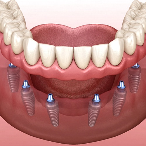 Model of implant dentures in Willowbrook, IL