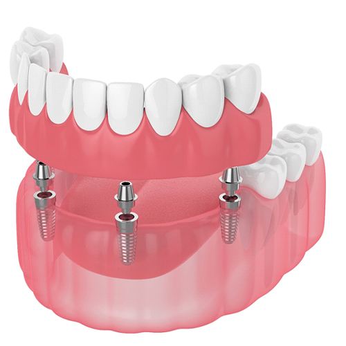 Removable partial implant dentures in Willowbrook, IL