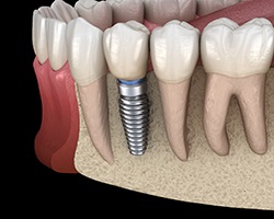 Diagram of an integrated dental implant in Willowbrook