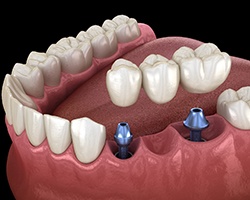 Diagram of implant bridge hovering over dental implants in Willowbrook